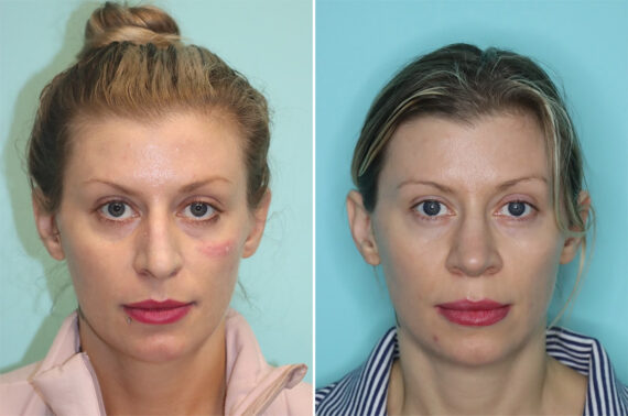 Before and after Rhinoplasty by Dr. Shervin Naderi, Patient 36477
