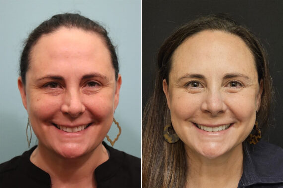 Before and after Rhinoplasty by Dr. Shervin Naderi, Patient 36484