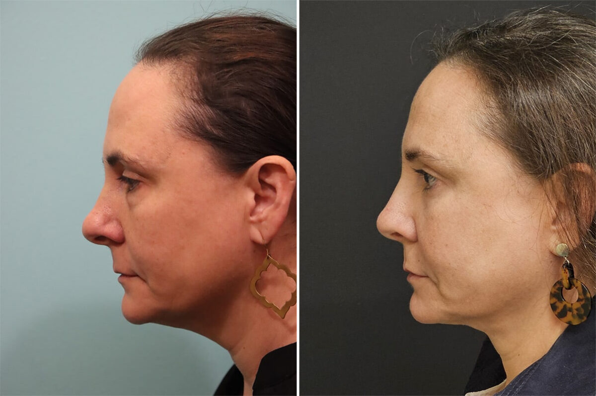 Before and after Rhinoplasty by Dr. Shervin Naderi, Patient 36484
