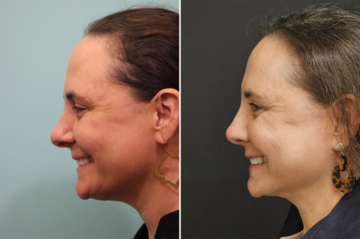 Before and after Rhinoplasty by Dr. Shervin Naderi, Patient 36484