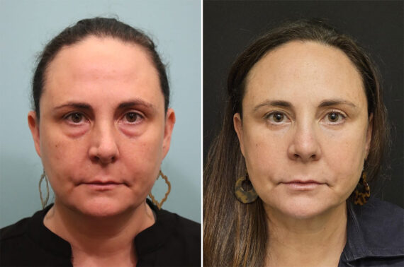 Before and after Rhinoplasty by Dr. Shervin Naderi, Patient 36484