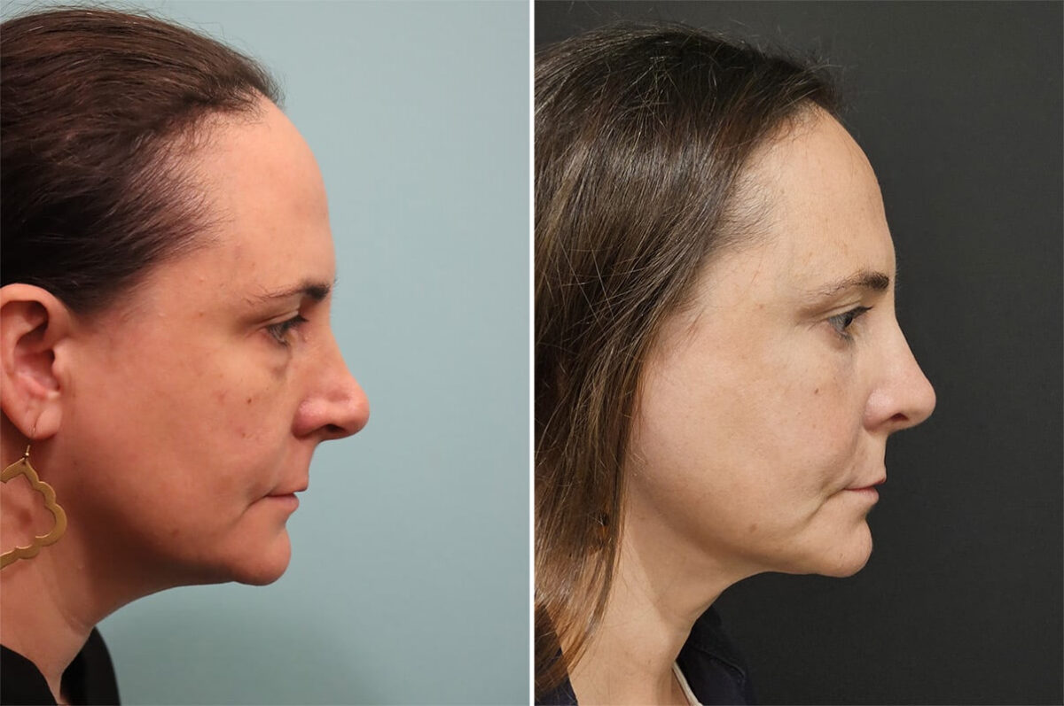 Before and after Rhinoplasty by Dr. Shervin Naderi, Patient 36484