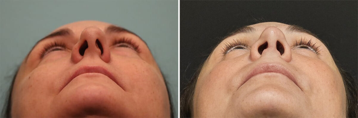 Before and after Rhinoplasty by Dr. Shervin Naderi, Patient 36484