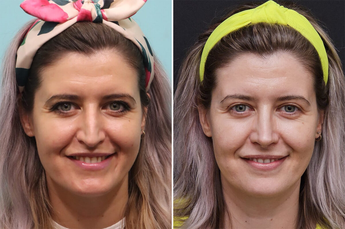 Before and after Rhinoplasty by Dr. Shervin Naderi, Patient 36493