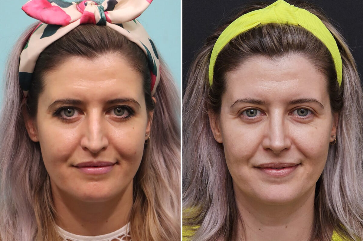 Before and after Rhinoplasty by Dr. Shervin Naderi, Patient 36493