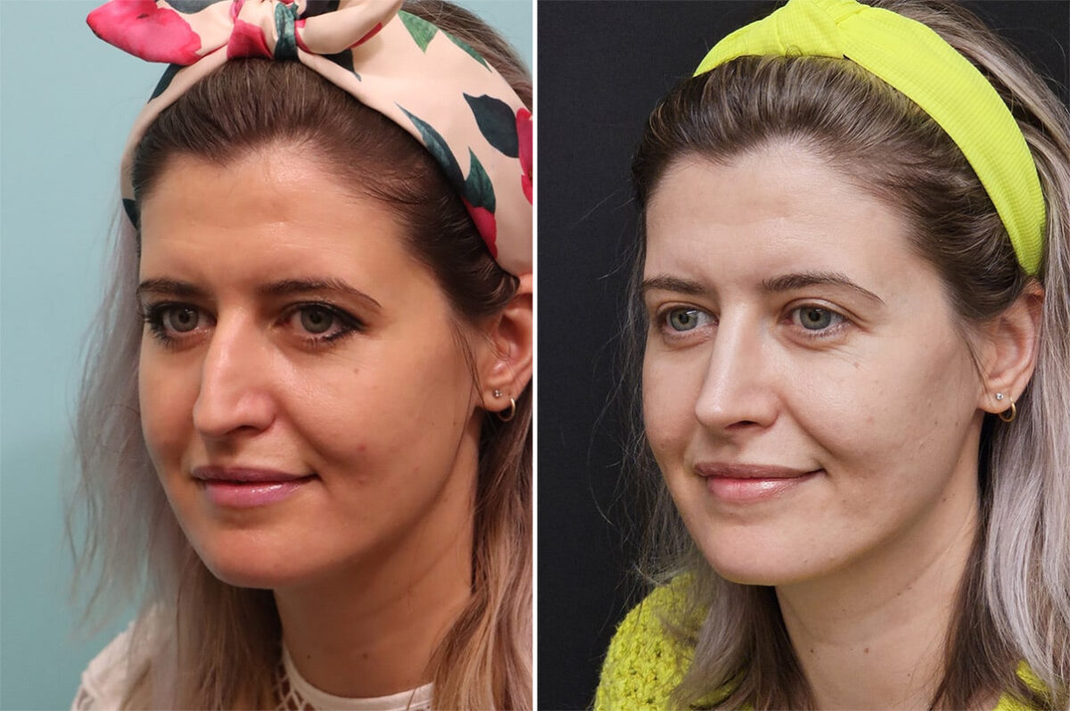 Before and after Rhinoplasty by Dr. Shervin Naderi, Patient 36493
