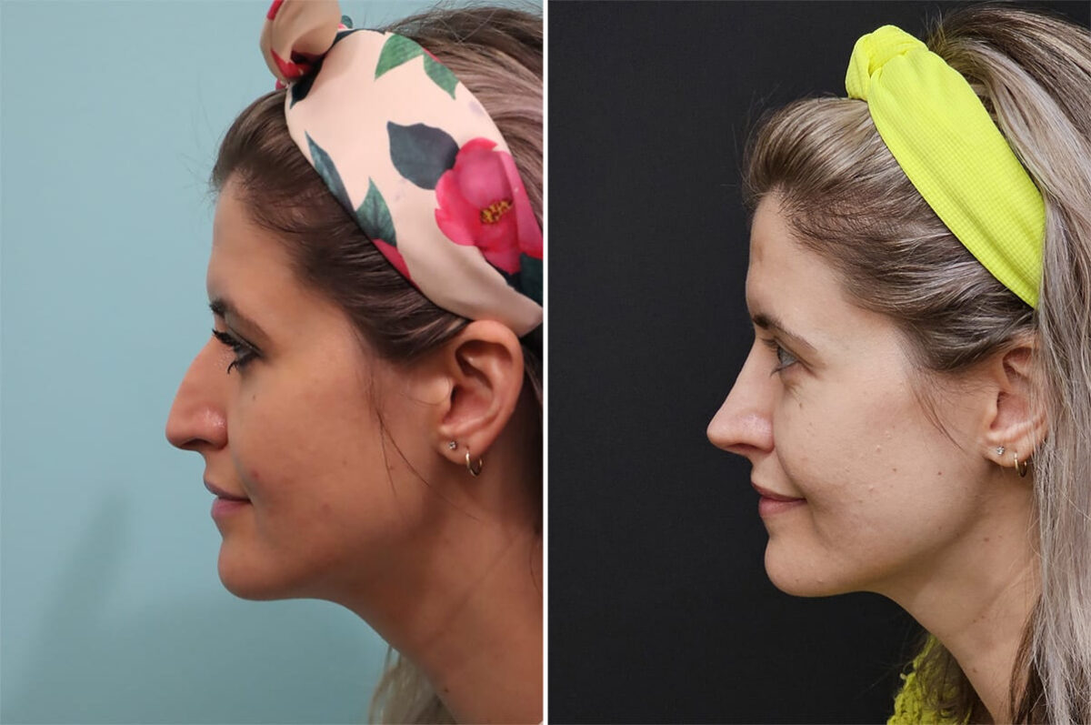 Before and after Rhinoplasty by Dr. Shervin Naderi, Patient 36493