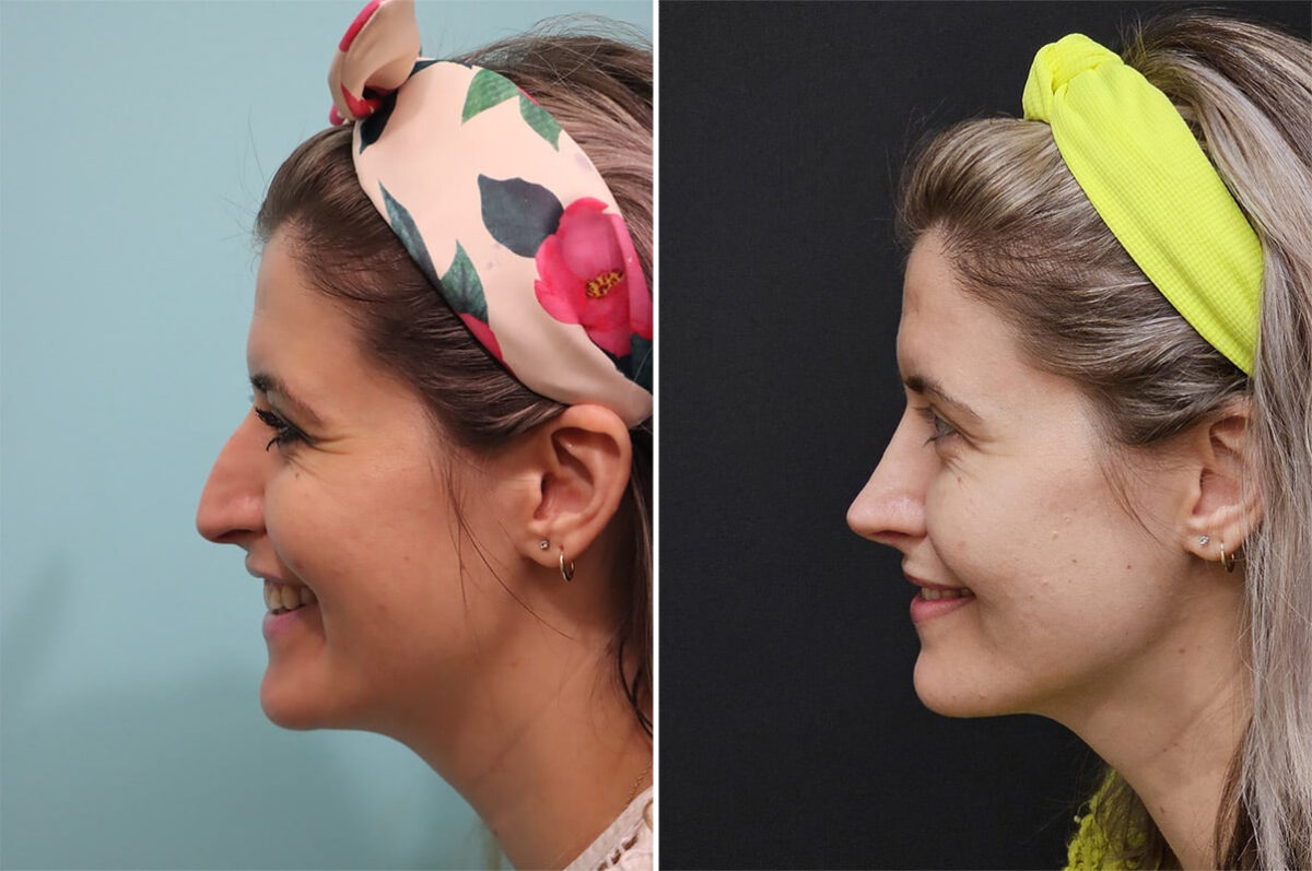 Before and after Rhinoplasty by Dr. Shervin Naderi, Patient 36493