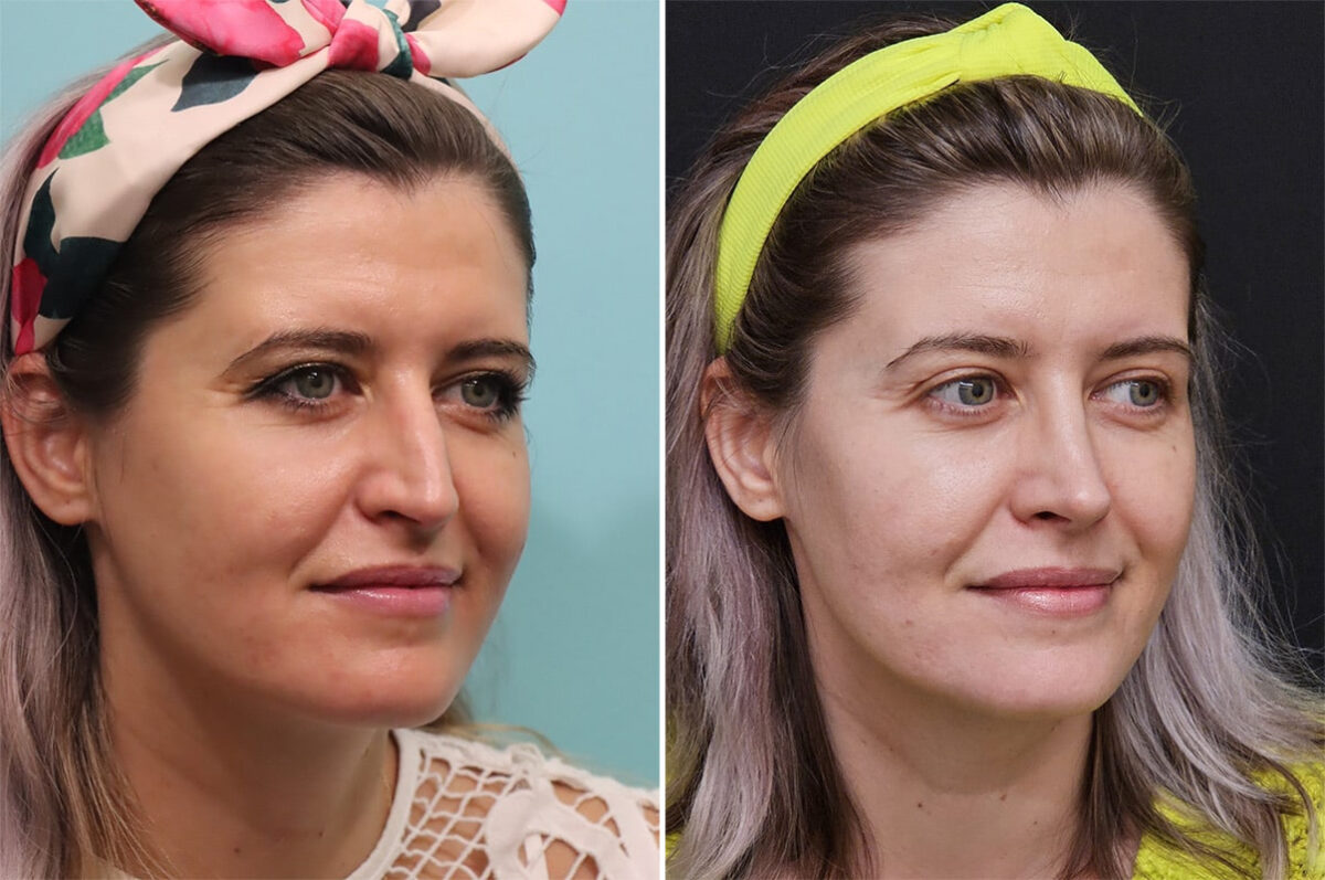 Before and after Rhinoplasty by Dr. Shervin Naderi, Patient 36493