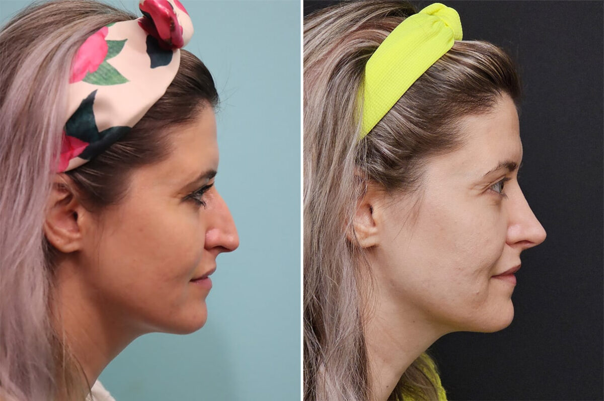 Before and after Rhinoplasty by Dr. Shervin Naderi, Patient 36493