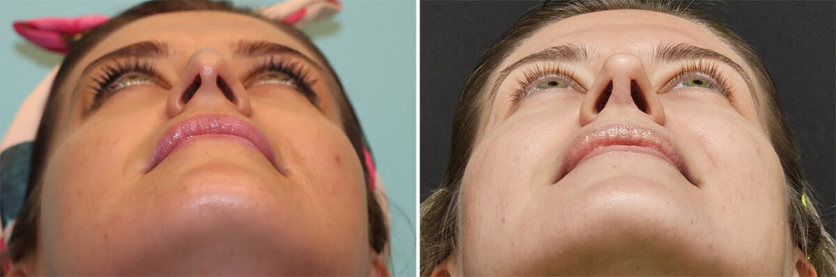 Before and after Rhinoplasty by Dr. Shervin Naderi, Patient 36493