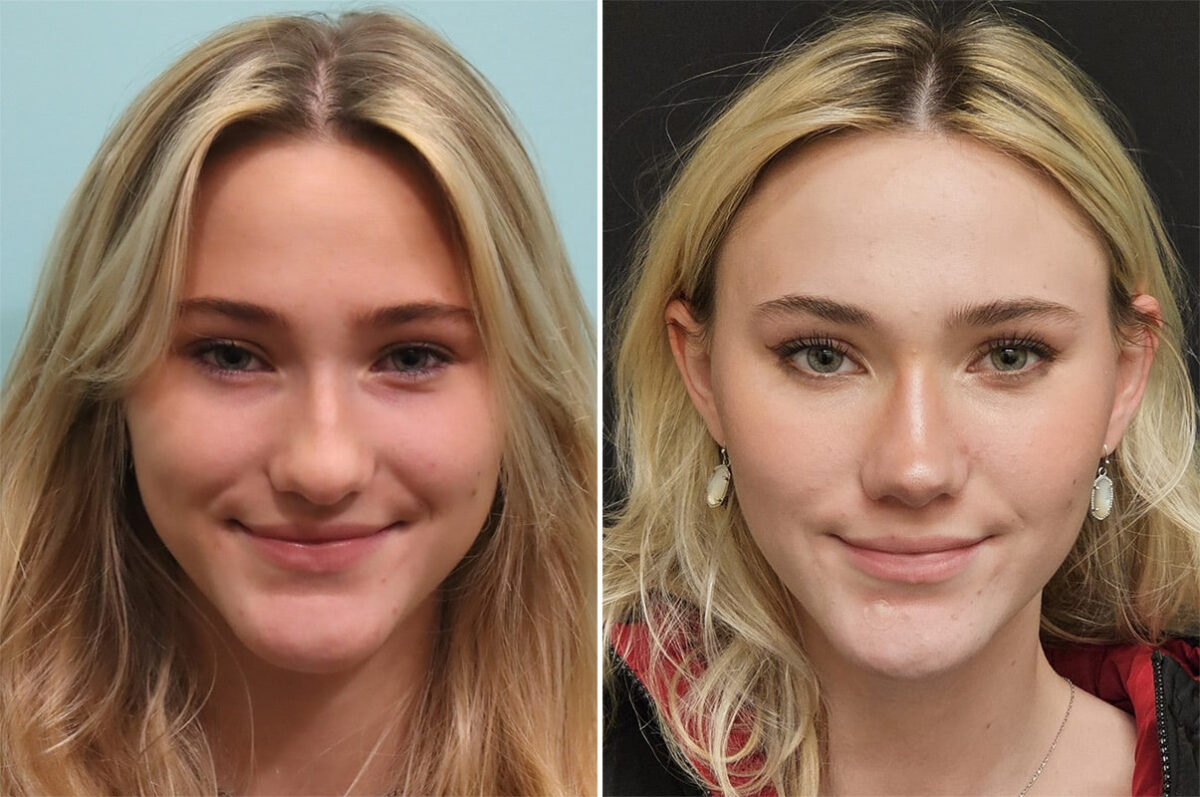 Before and after Rhinoplasty by Dr. Shervin Naderi, Patient 36502