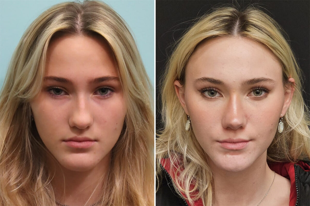 Before and after Rhinoplasty by Dr. Shervin Naderi, Patient 36502