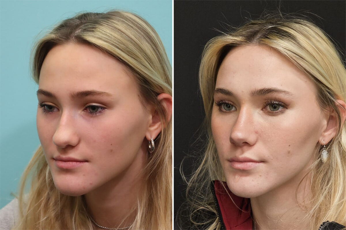 Before and after Rhinoplasty by Dr. Shervin Naderi, Patient 36502