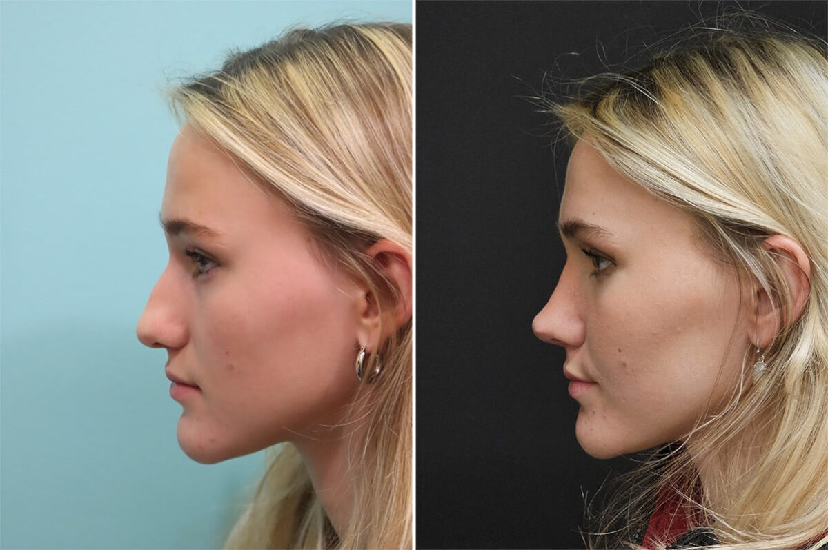 Before and after Rhinoplasty by Dr. Shervin Naderi, Patient 36502