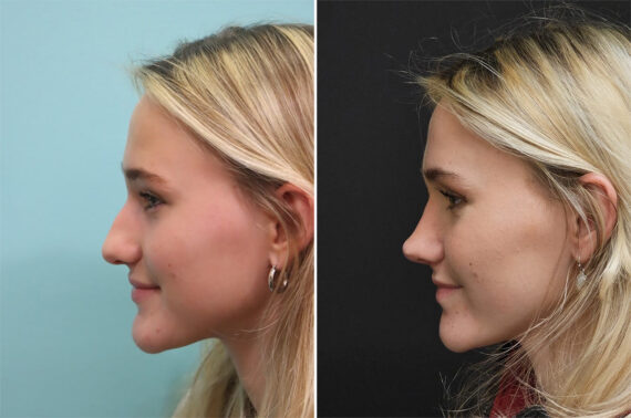 Before and after Rhinoplasty by Dr. Shervin Naderi, Patient 36502