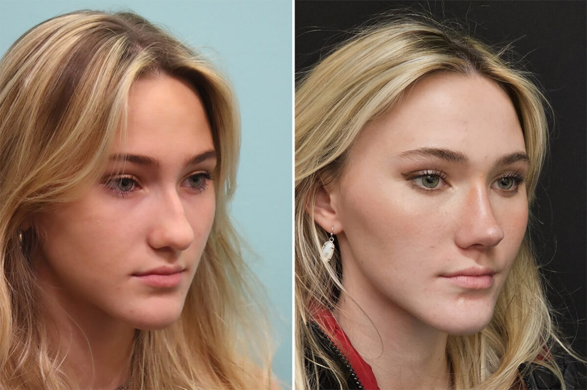 Before and after Rhinoplasty by Dr. Shervin Naderi, Patient 36502