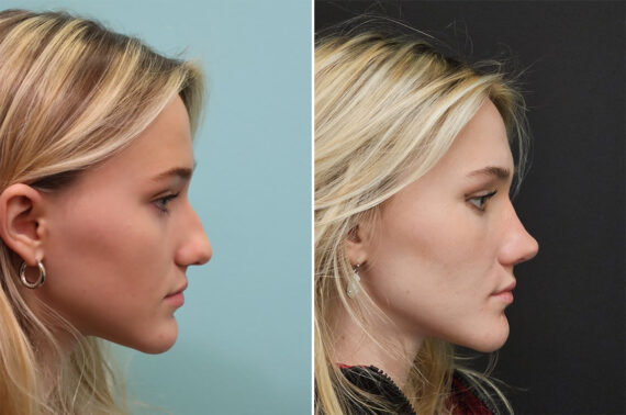 Before and after Rhinoplasty by Dr. Shervin Naderi, Patient 36502