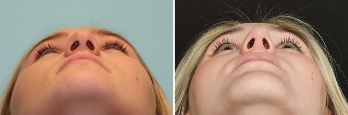Before and after Rhinoplasty by Dr. Shervin Naderi, Patient 36502