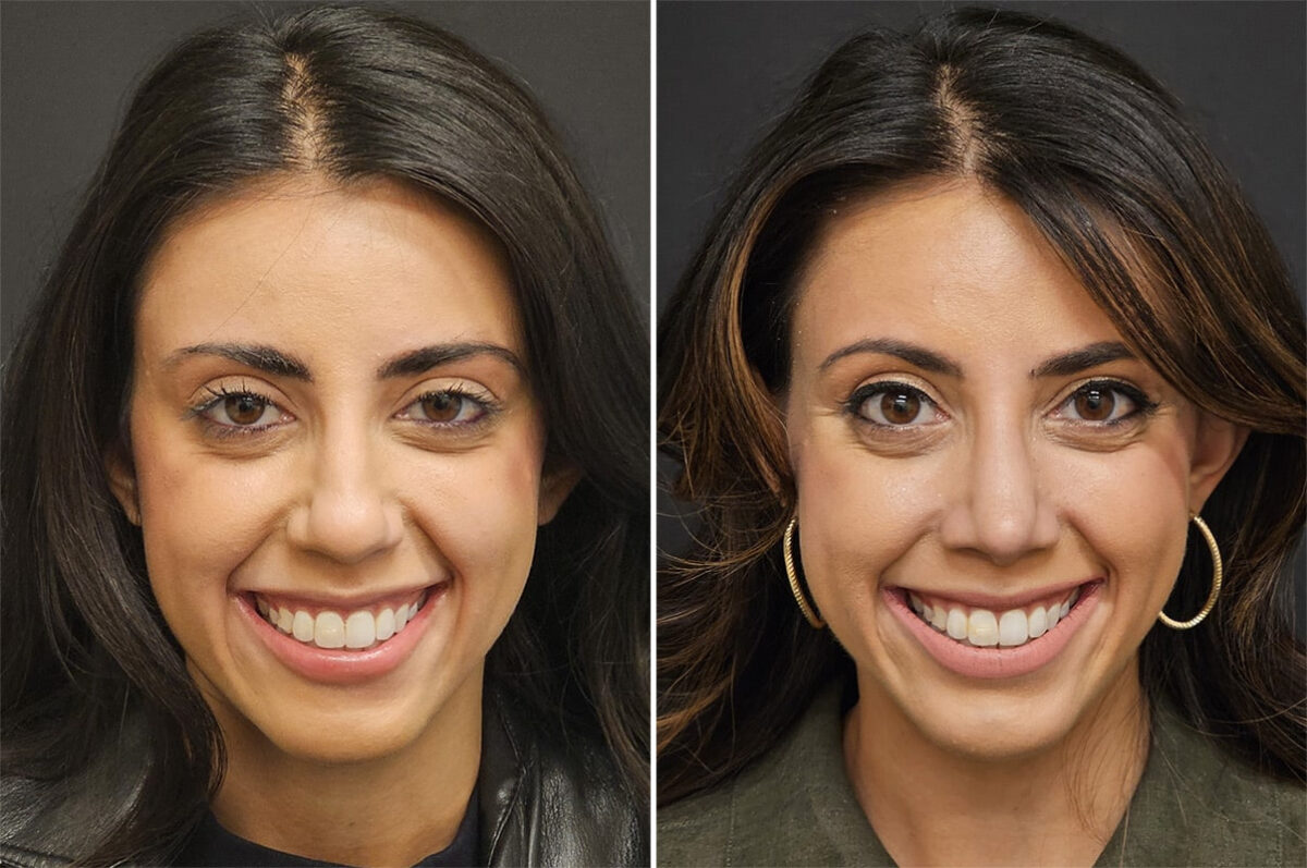 Before and after Rhinoplasty by Dr. Shervin Naderi, Patient 36521