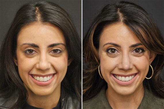 Before and after Rhinoplasty by Dr. Shervin Naderi, Patient 36521