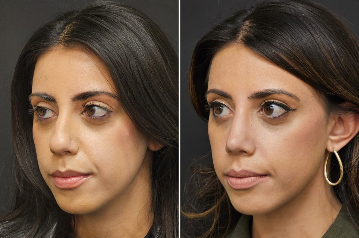 Before and after Rhinoplasty by Dr. Shervin Naderi, Patient 36521