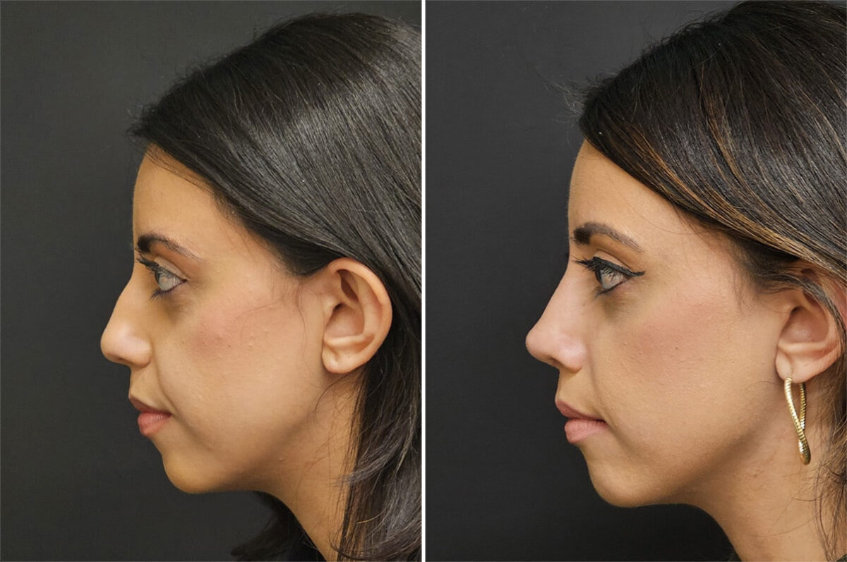 Before and after Rhinoplasty by Dr. Shervin Naderi, Patient 36521