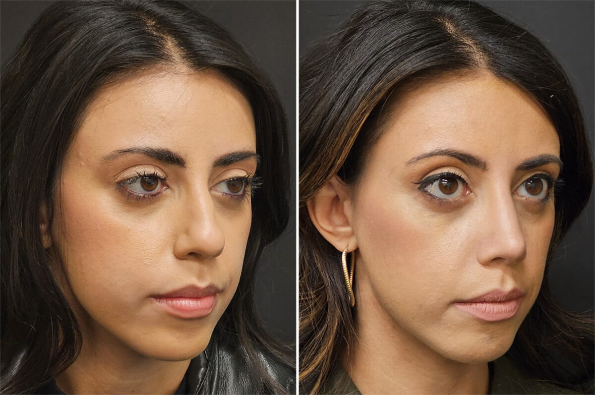Before and after Rhinoplasty by Dr. Shervin Naderi, Patient 36521