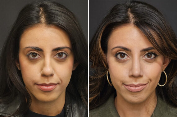 Before and after Rhinoplasty by Dr. Shervin Naderi, Patient 36521