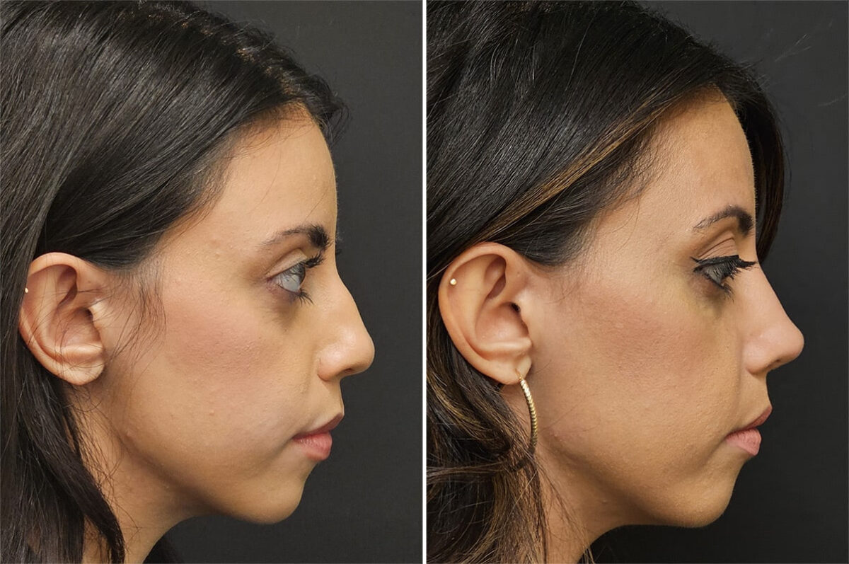 Before and after Rhinoplasty by Dr. Shervin Naderi, Patient 36521