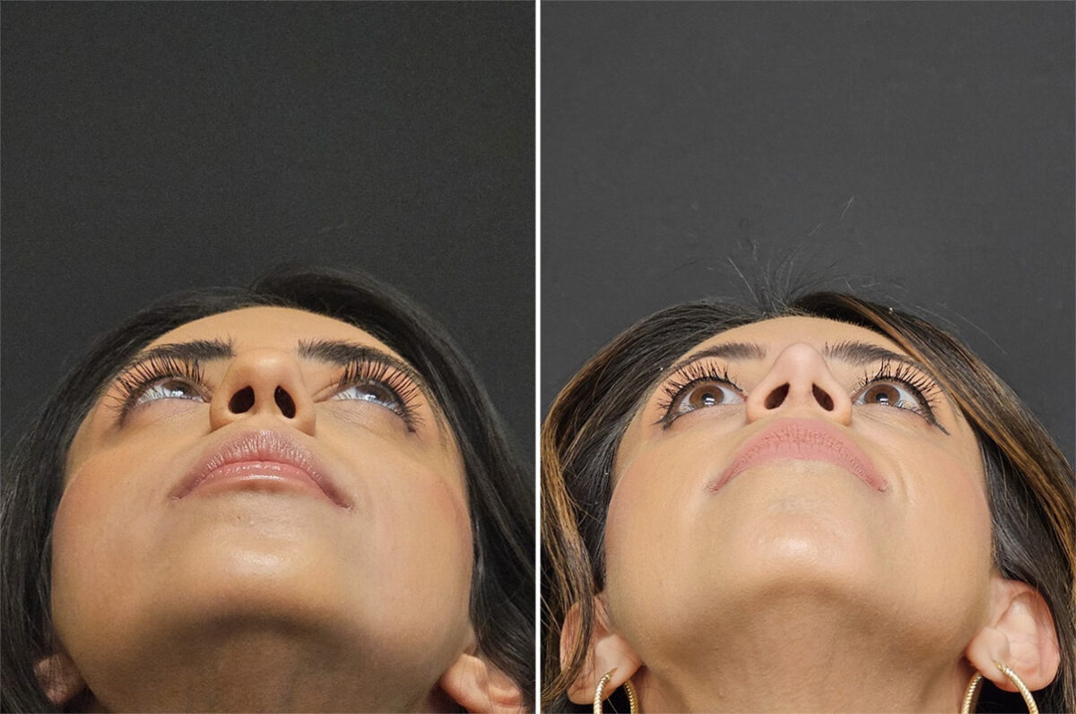 Before and after Rhinoplasty by Dr. Shervin Naderi, Patient 36521