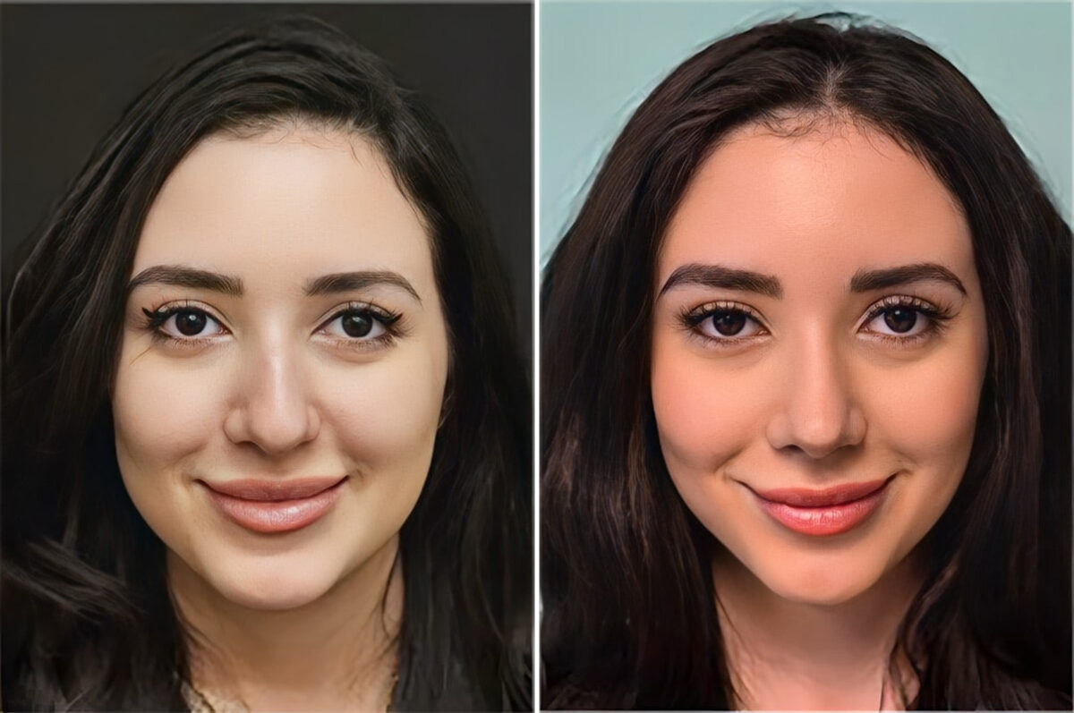Before and after Rhinoplasty by Dr. Shervin Naderi, Patient 36590