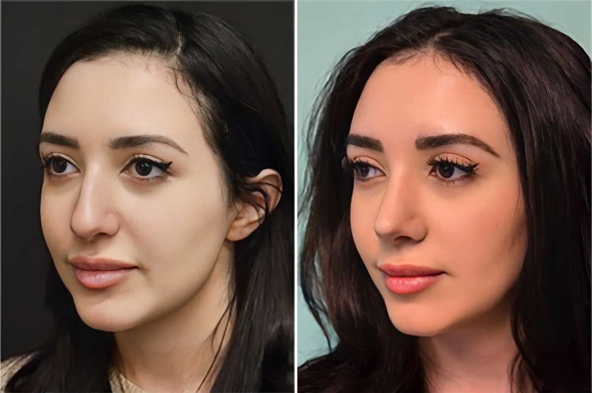 Before and after Rhinoplasty by Dr. Shervin Naderi, Patient 36590
