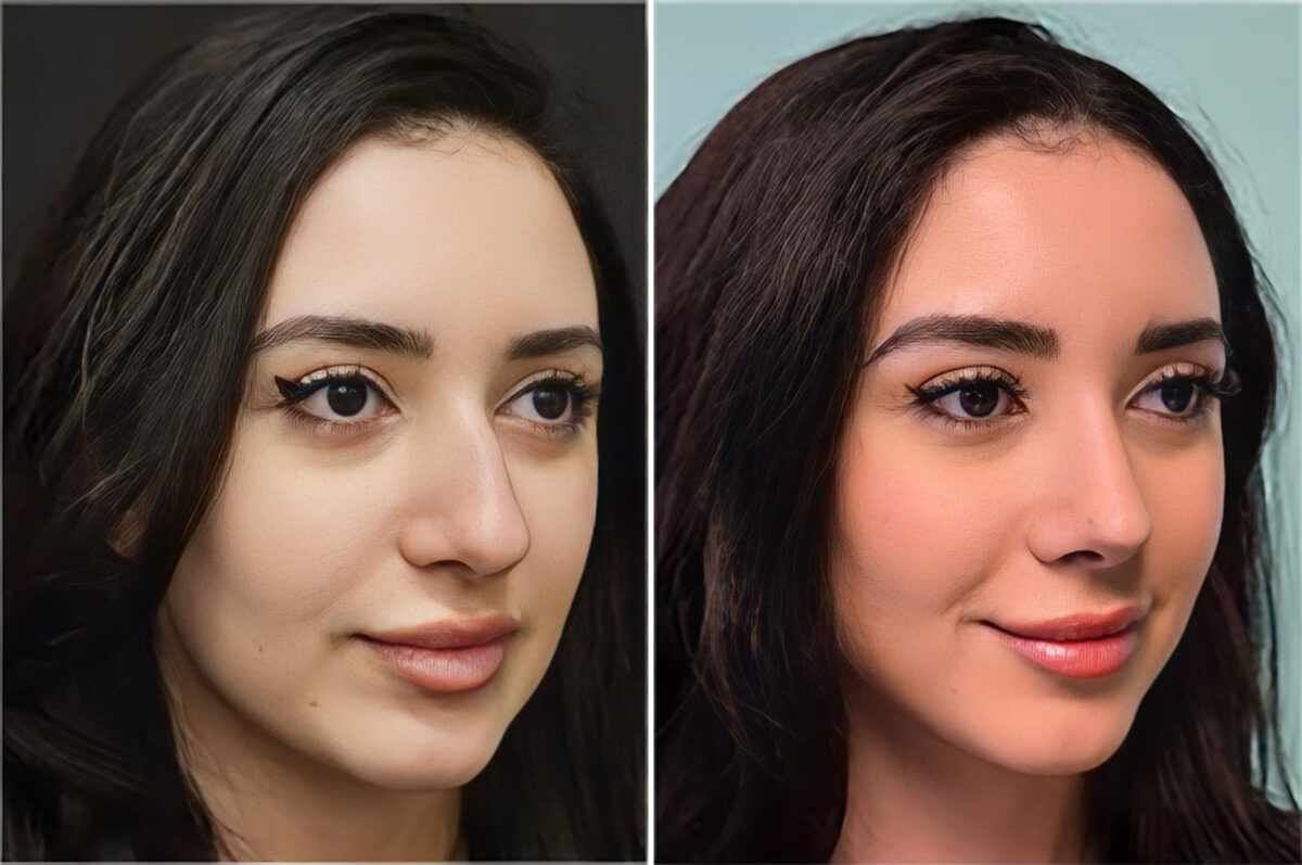 Before and after Rhinoplasty by Dr. Shervin Naderi, Patient 36590