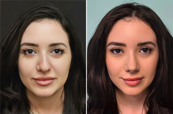 Before and after Rhinoplasty by Dr. Shervin Naderi, Patient 36590