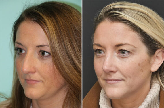 Before and after Rhinoplasty by Dr. Shervin Naderi, Patient 36595