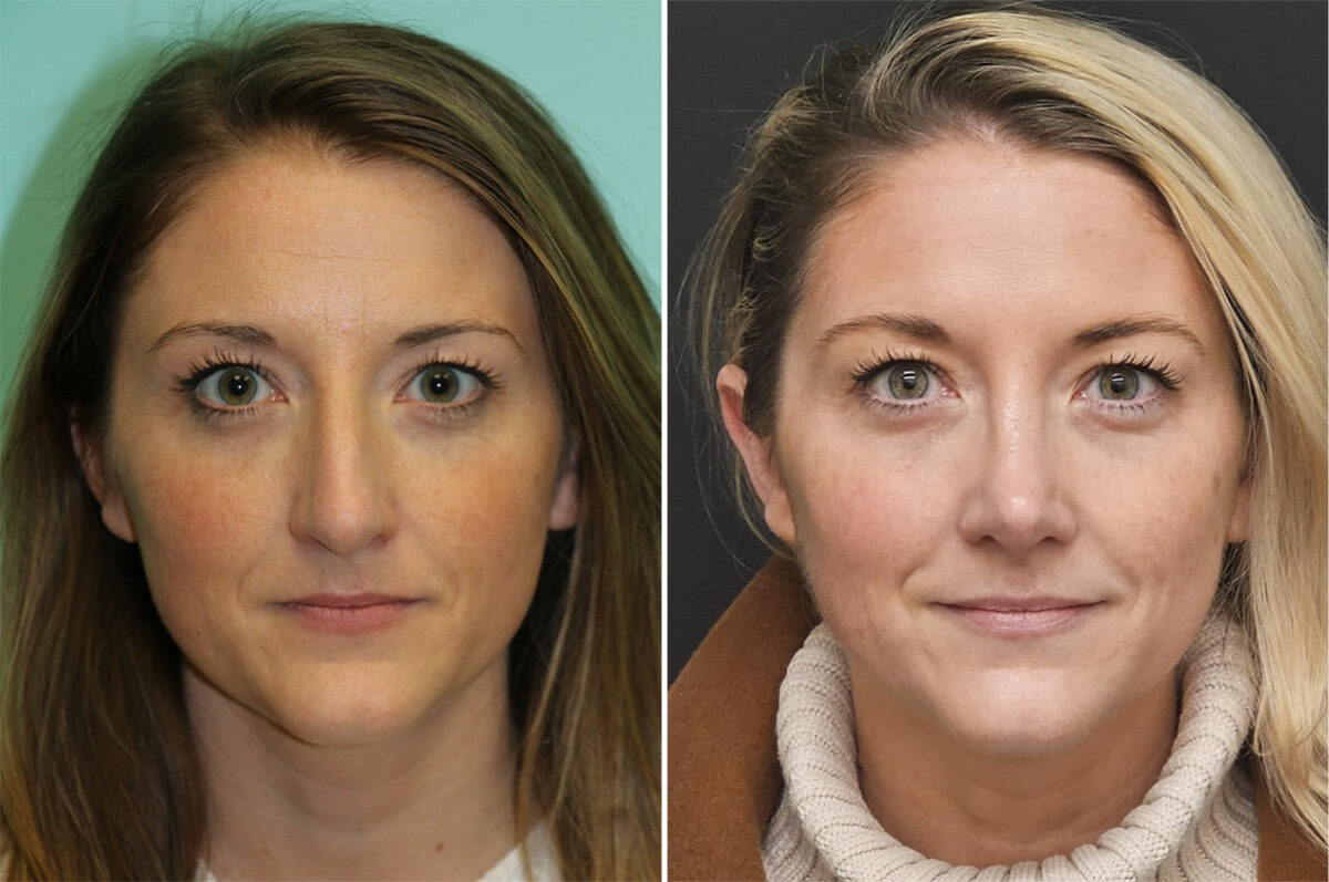 Before and after Rhinoplasty by Dr. Shervin Naderi, Patient 36595