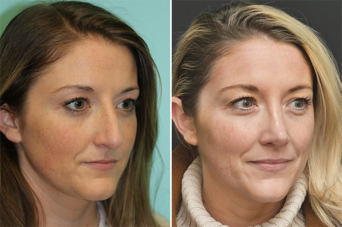 Before and after Rhinoplasty by Dr. Shervin Naderi, Patient 36595