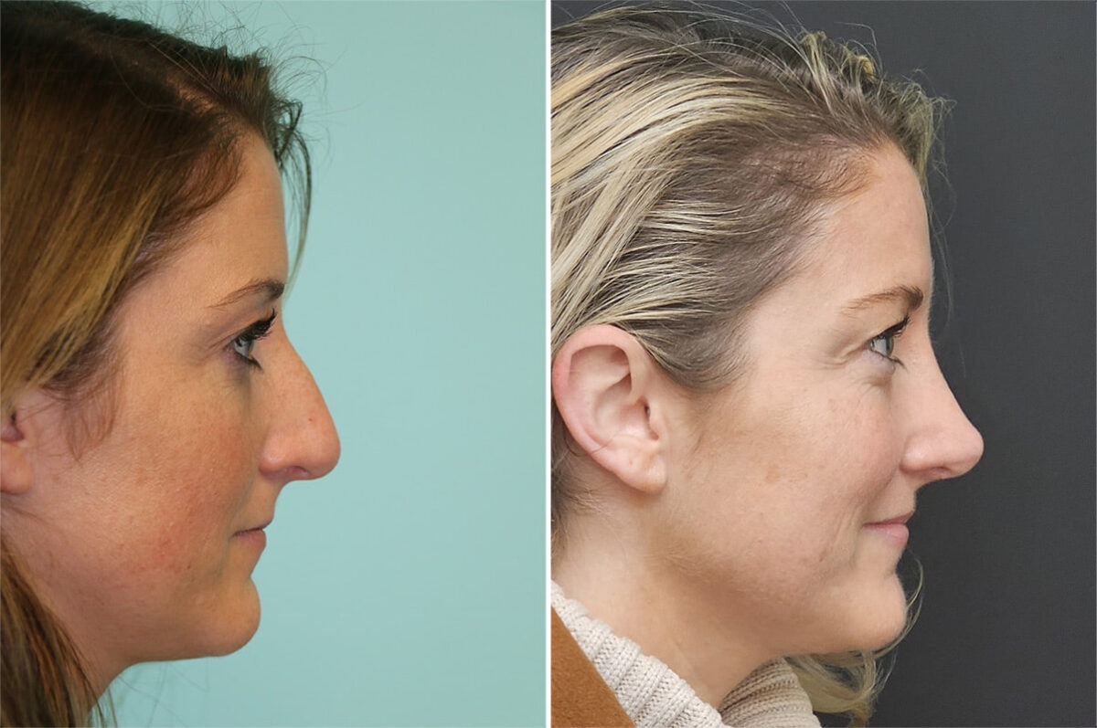Before and after Rhinoplasty by Dr. Shervin Naderi, Patient 36595