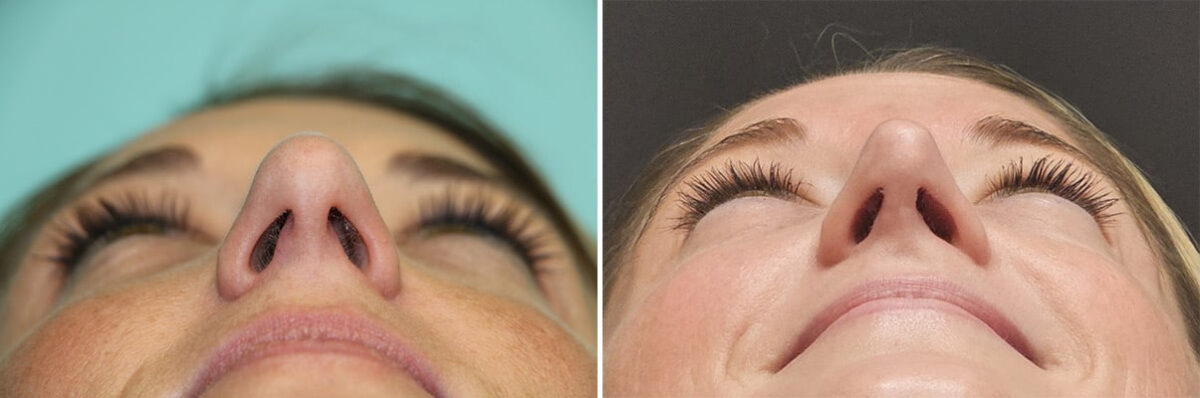 Before and after Rhinoplasty by Dr. Shervin Naderi, Patient 36595