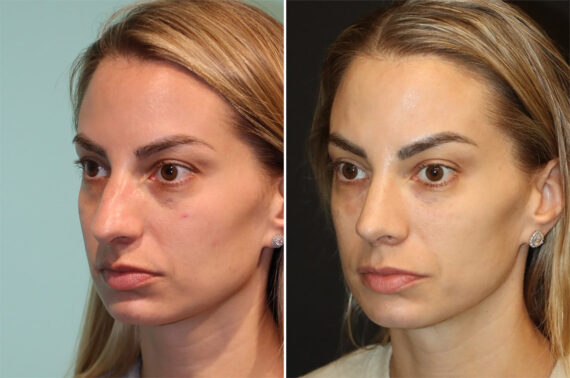 Before and after Rhinoplasty by Dr. Shervin Naderi, Patient 36602