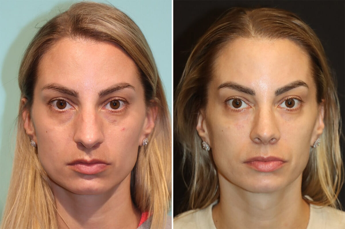 Before and after Rhinoplasty by Dr. Shervin Naderi, Patient 36602