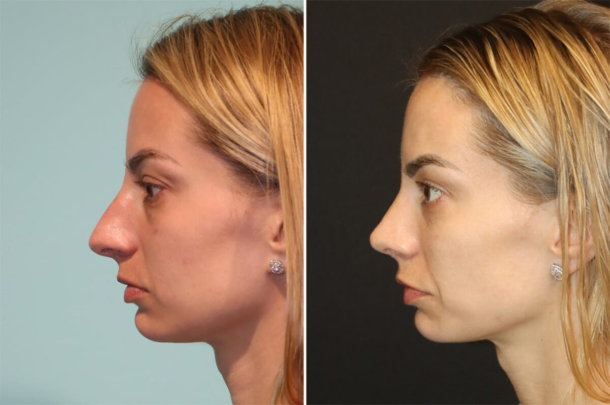 Before and after Rhinoplasty by Dr. Shervin Naderi, Patient 36602