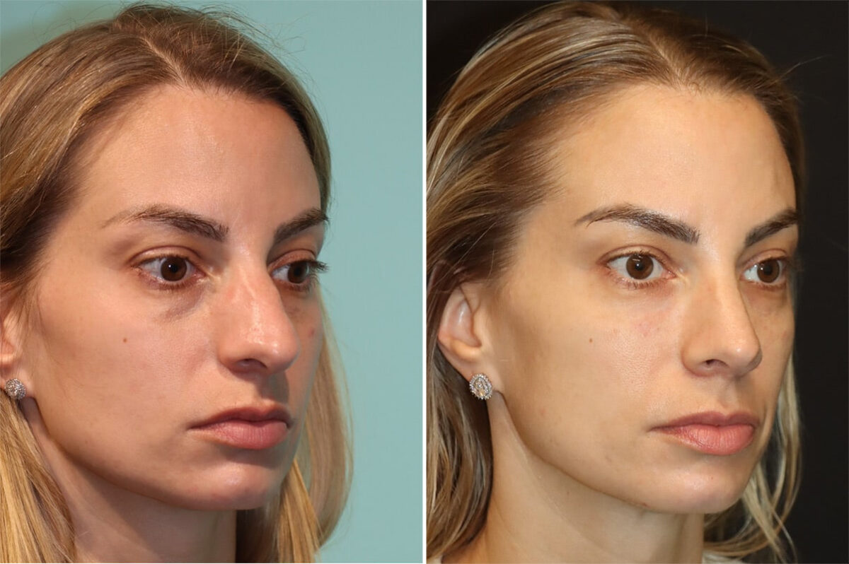 Before and after Rhinoplasty by Dr. Shervin Naderi, Patient 36602