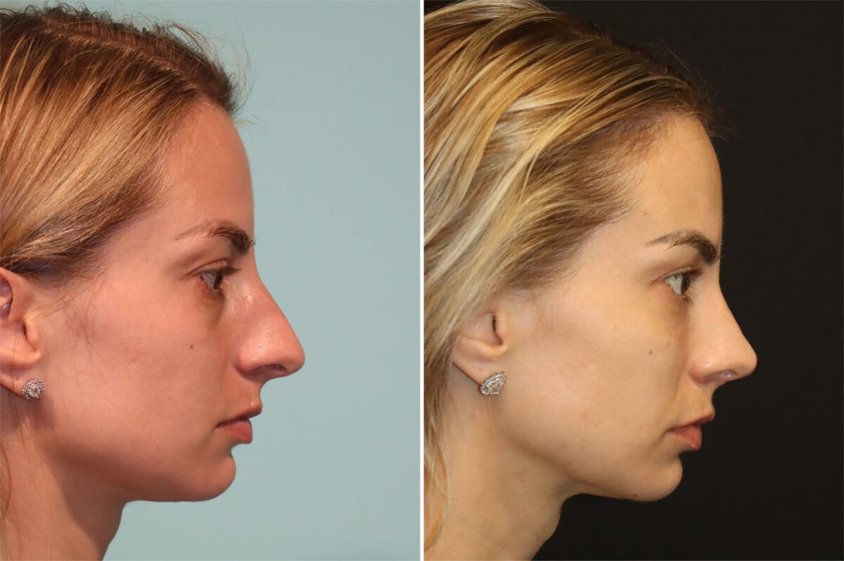 Before and after Rhinoplasty by Dr. Shervin Naderi, Patient 36602