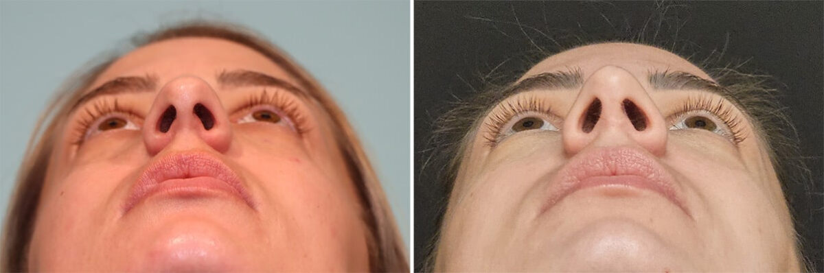 Before and after Rhinoplasty by Dr. Shervin Naderi, Patient 36602