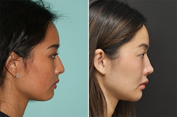 Before and after Cheeks / Midface Injections by Dr. Shervin Naderi, Patient 36609