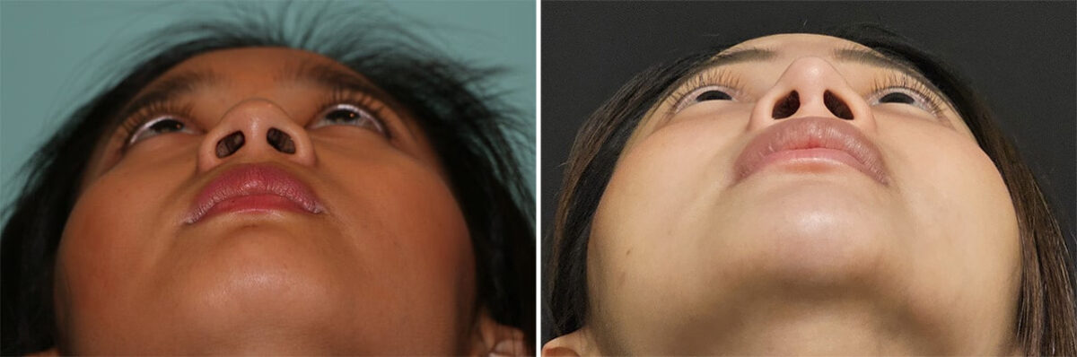 Before and after Cheeks / Midface Injections by Dr. Shervin Naderi, Patient 36609