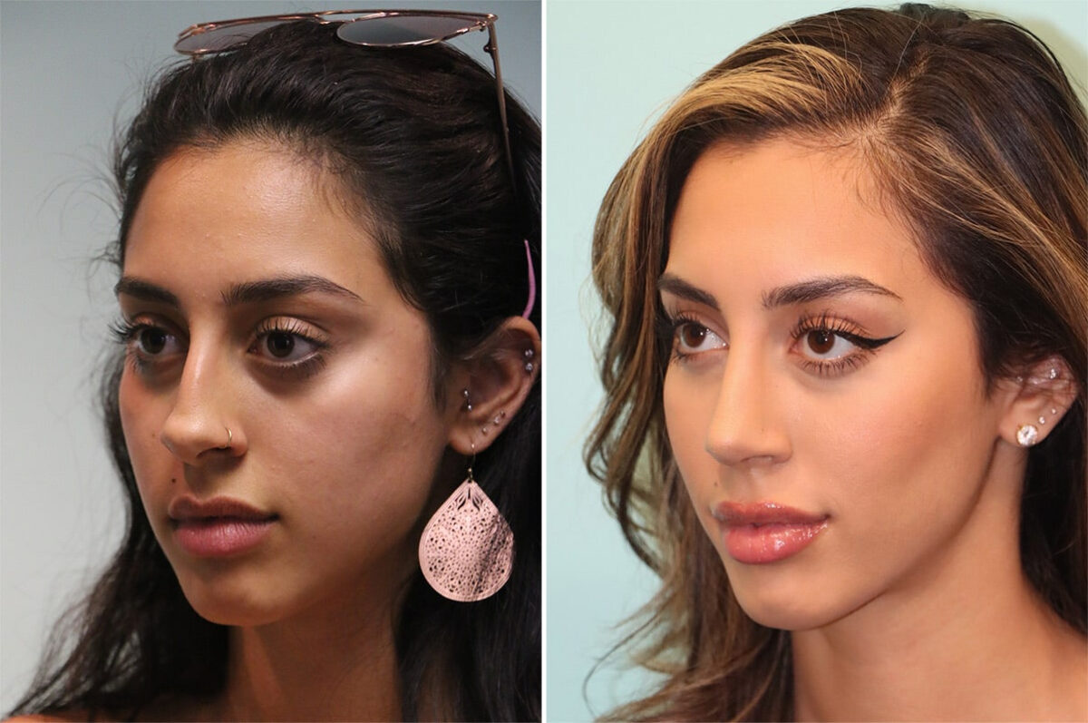 Before and after Rhinoplasty by Dr. Shervin Naderi, Patient 36618