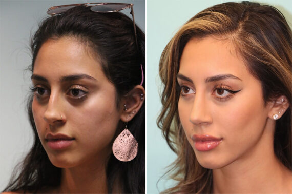 Before and after Rhinoplasty by Dr. Shervin Naderi, Patient 36618